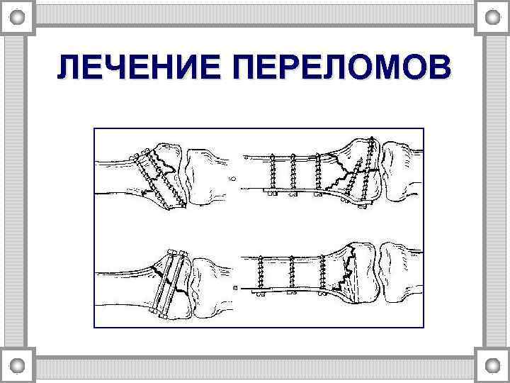 ЛЕЧЕНИЕ ПЕРЕЛОМОВ 