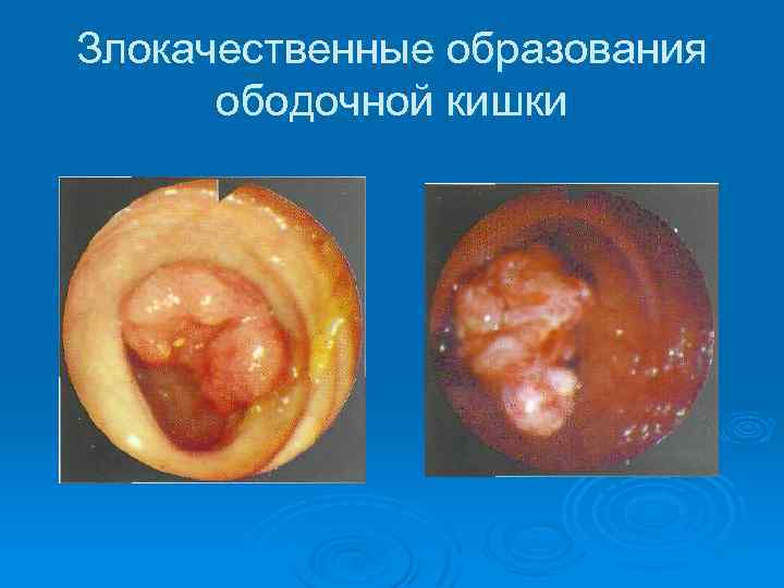 Злокачественные образования ободочной кишки 
