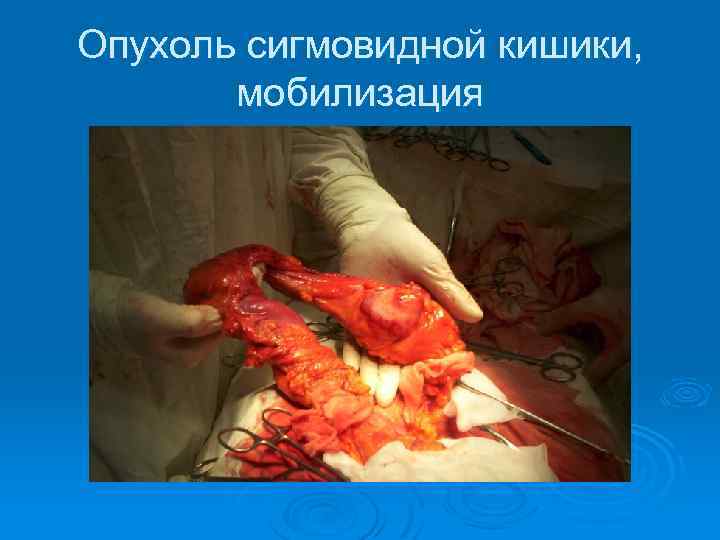 Опухоль сигмовидной кишики, мобилизация 