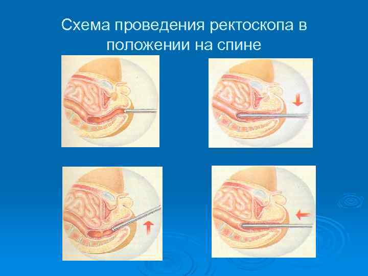 Схема проведения ректоскопа в положении на спине 