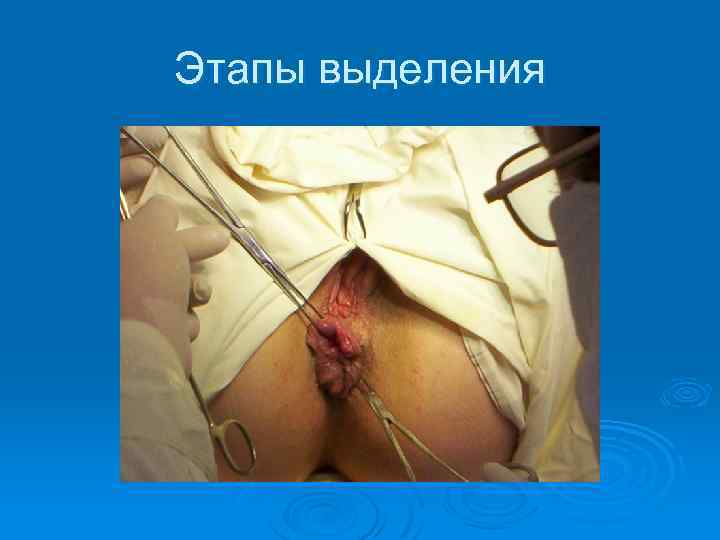 Этапы выделения 