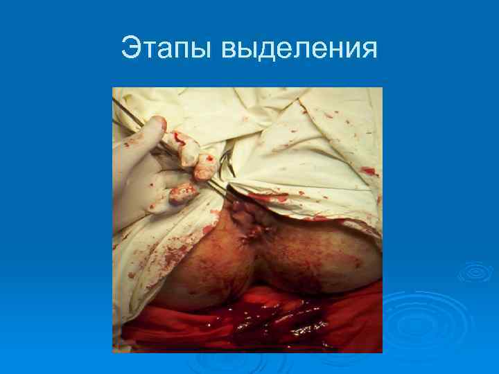 Этапы выделения 