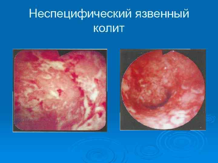 Неспецифический язвенный колит 