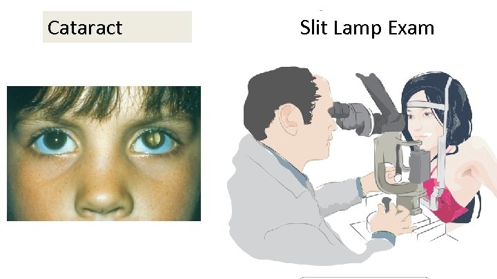 Cataract Slit Lamp Exam 