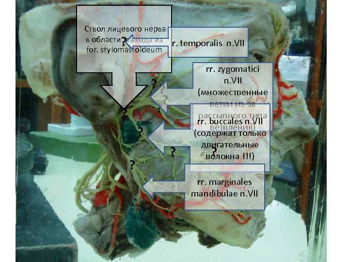  Ствол лицевого нерва в области выхода из r. temporalis n. VII ? for.