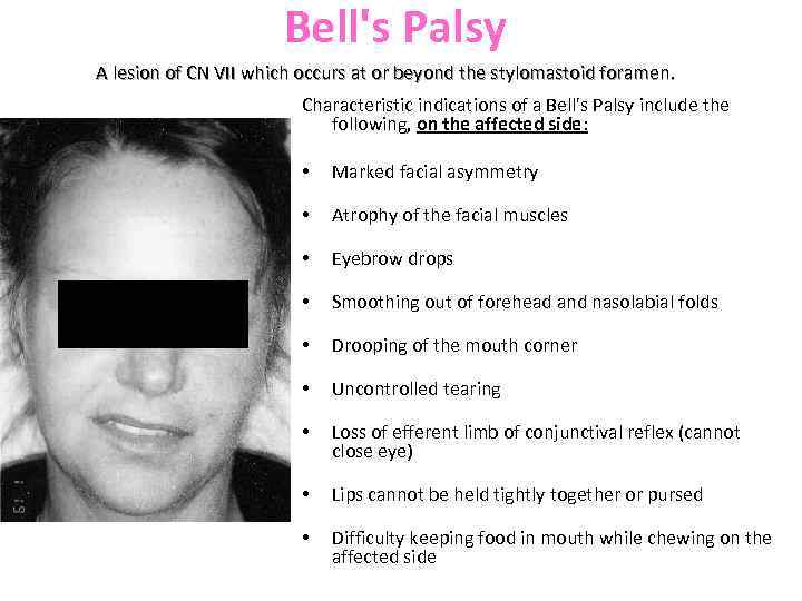 Bell's Palsy A lesion of CN VII which occurs at or beyond the stylomastoid