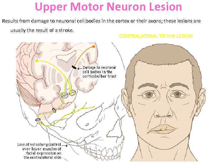 Upper Motor Neuron Lesion Results from damage to neuronal cell bodies in the cortex