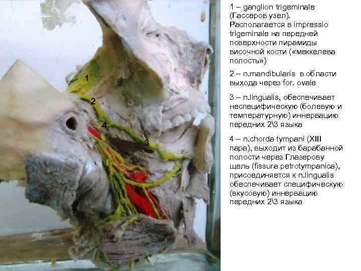 1 – ganglion trigeminale (Гассеров узел). Располагается в impressio trigeminale на передней поверхности пирамиды