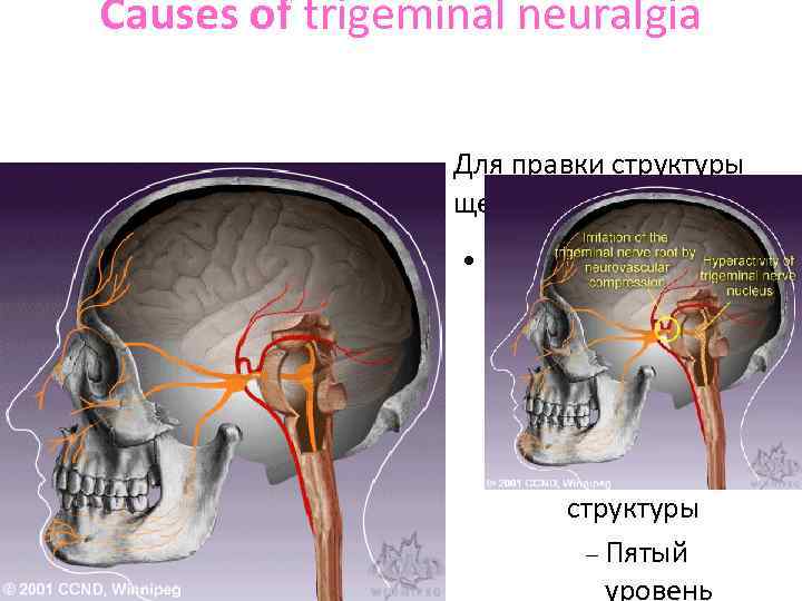 Causes of trigeminal neuralgia 1. compression upon the trigeminal nerve root by one or