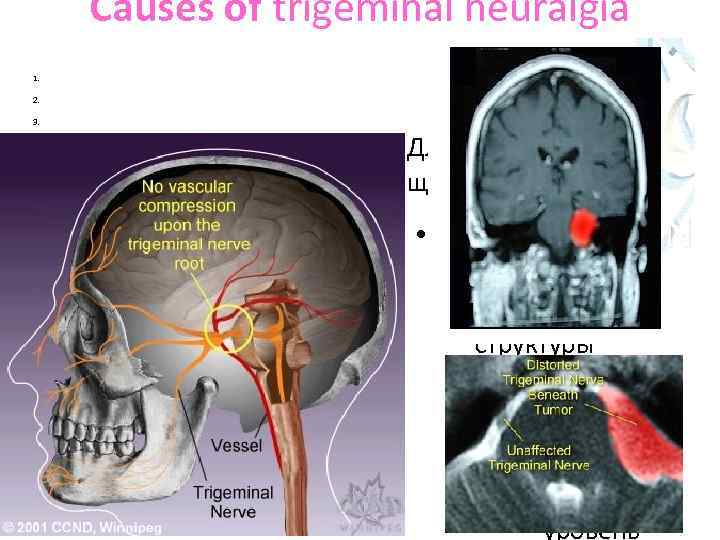 Causes of trigeminal neuralgia 1. 2. 3. multiple-sclerosis-related TN tumor related TN post-traumatic TN
