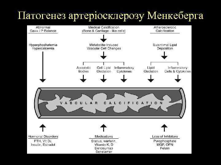 Патогенез артеріосклерозу Менкеберга 