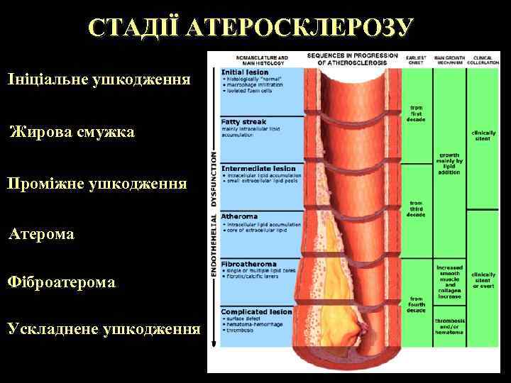 СТАДІЇ АТЕРОСКЛЕРОЗУ Ініціальне ушкодження Жирова смужка Проміжне ушкодження Атерома Фіброатерома Ускладнене ушкодження 