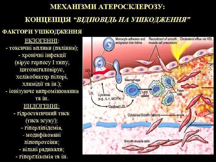 МЕХАНІЗМИ АТЕРОСКЛЕРОЗУ: КОНЦЕПЦІЯ “ВІДПОВІДЬ НА УШКОДЖЕННЯ” ФАКТОРИ УШКОДЖЕННЯ ЕКЗОГЕННІ: - токсичні впливи (паління); -