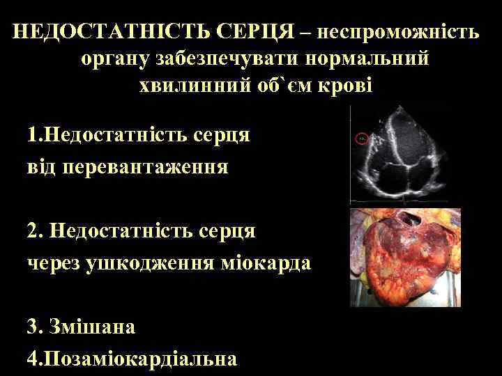 НЕДОСТАТНІСТЬ СЕРЦЯ – неспроможність органу забезпечувати нормальний хвилинний об`єм крові 1. Недостатність серця від