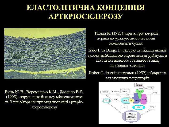 ЕЛАСТОЛІТИЧНА КОНЦЕПЦІЯ АРТЕРІОСКЛЕРОЗУ Thoma R. (1921): при атеросклерозі первинно уражуються еластичні компоненти судин Balo