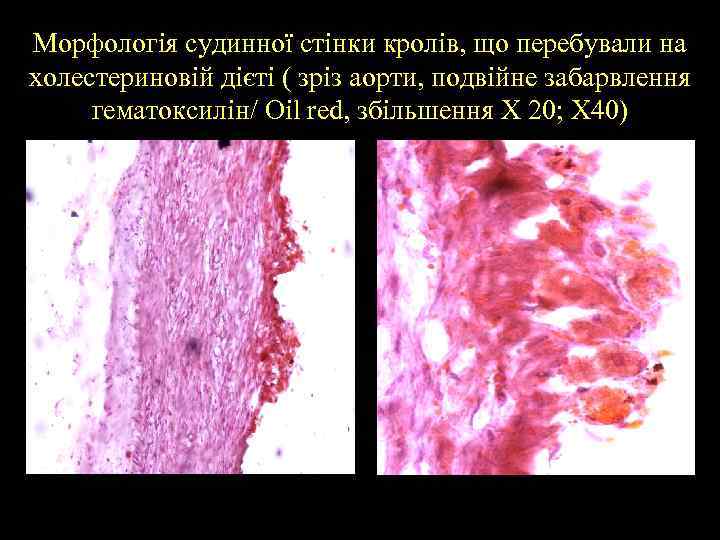 Морфологія судинної стінки кролів, що перебували на холестериновій дієті ( зріз аорти, подвійне забарвлення