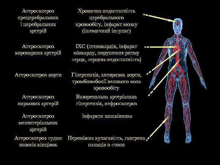 Атеросклероз прецеребральних і церебральних артерій Хронична недостатність церебрального кровообігу, інфаркт мозку (ішемичний інсульт) Атеросклероз