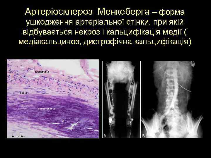 Артеріосклероз Менкеберга – форма ушкодження артеріальної стінки, при якій відбувається некроз і кальцифікація медії