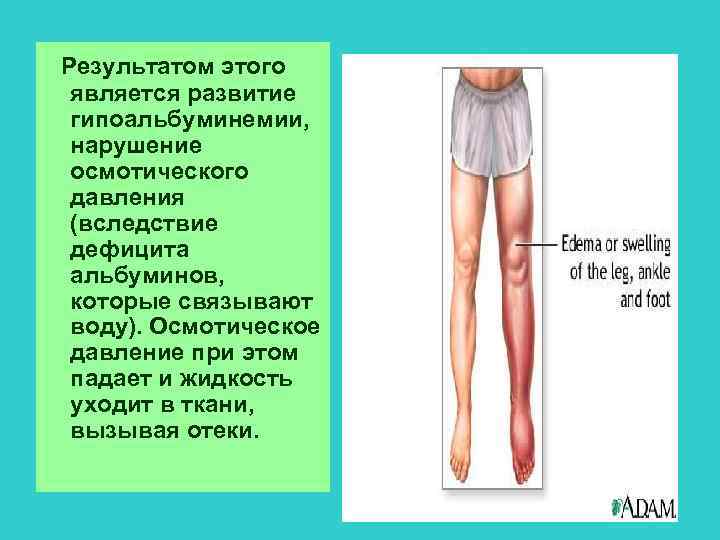 Результатом этого является развитие гипоальбуминемии, нарушение осмотического давления (вследствие дефицита альбуминов, которые связывают воду).