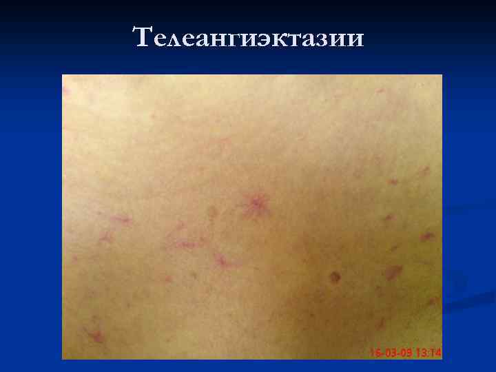 Телеангиэктазии 