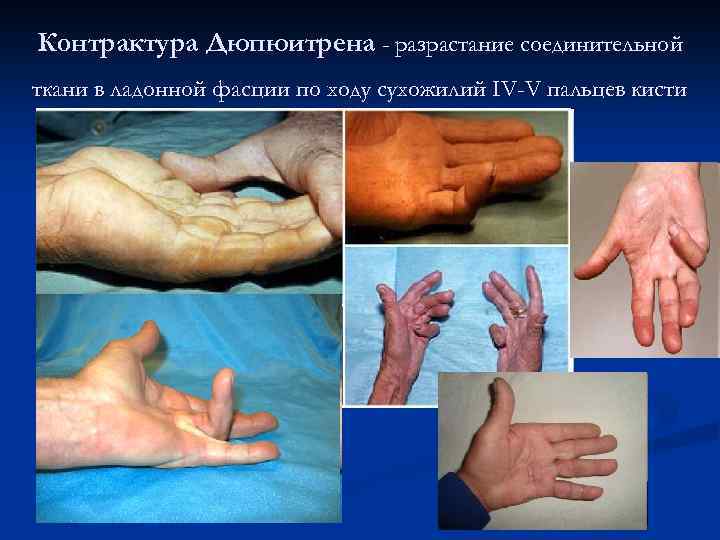 Контрактура Дюпюитрена - разрастание соединительной ткани в ладонной фасции по ходу сухожилий IV-V пальцев