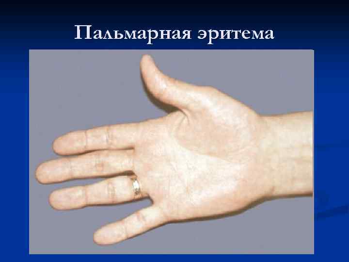 Пальмарная эритема 