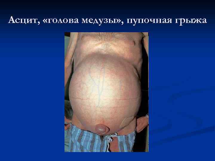 Асцит, «голова медузы» , пупочная грыжа 