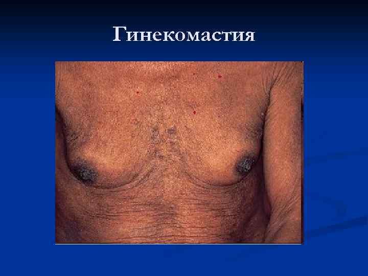 Гинекомастия 