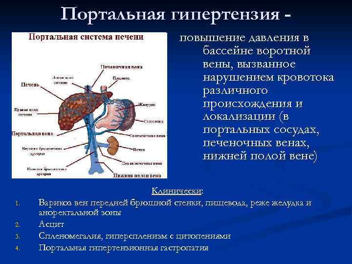 Портальная гипертензия повышение давления в бассейне воротной вены, вызванное нарушением кровотока различного происхождения и