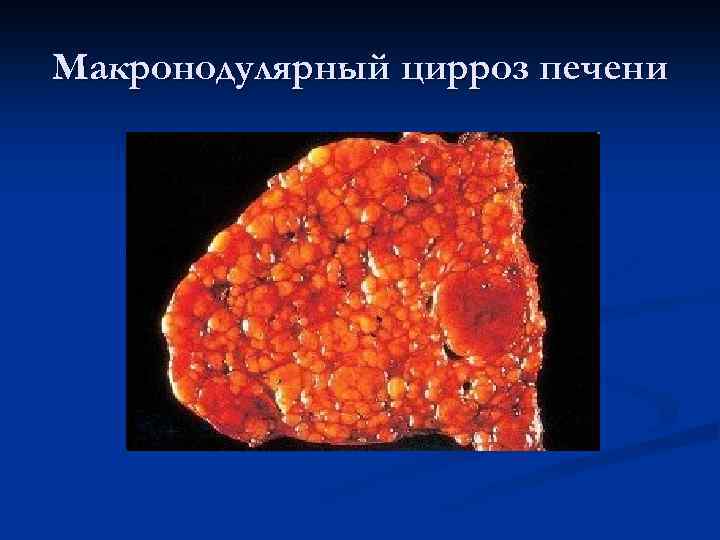 Макронодулярный цирроз печени 