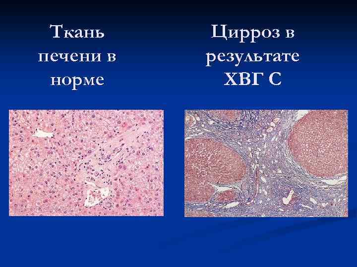 Ткань печени в норме Цирроз в результате ХВГ С 