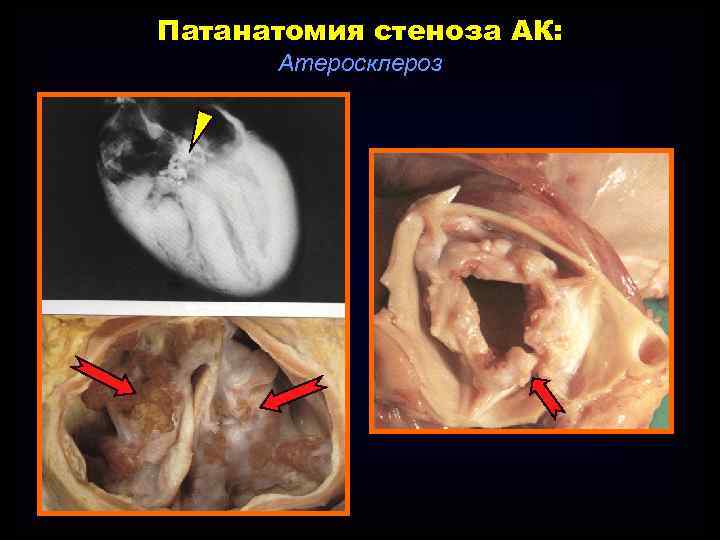 Патанатомия стеноза АК: Атеросклероз 