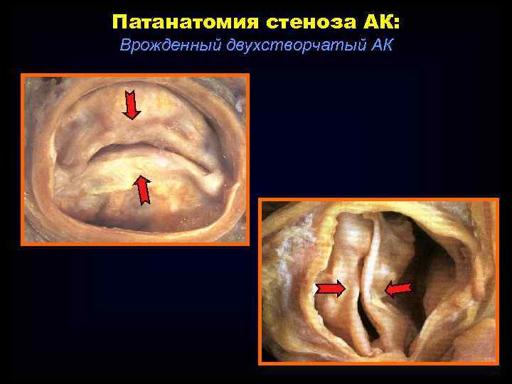 Патанатомия стеноза АК: Врожденный двухстворчатый АК 