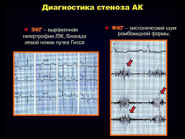 Диагностика стеноза АК ЭКГ – выраженная гипертрофия ЛЖ, блокада левой ножки пучка Гисса ФКГ