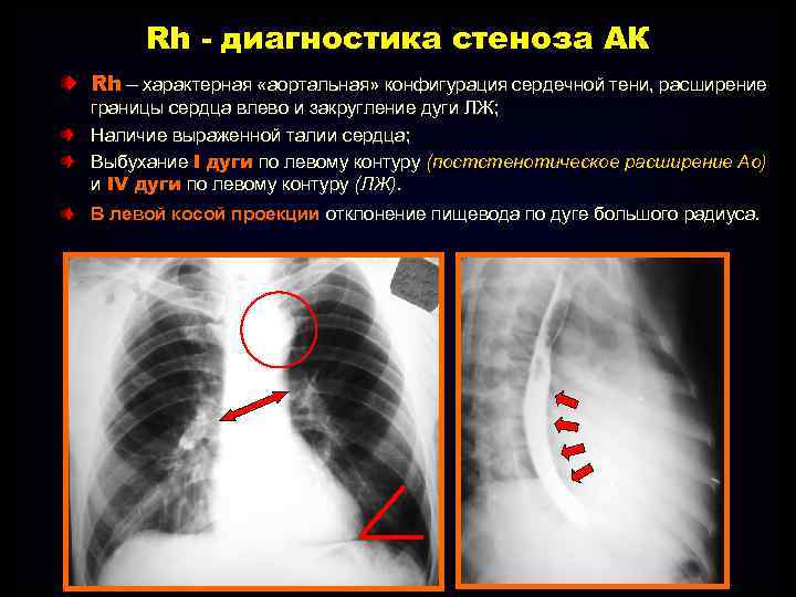 Расширение левой