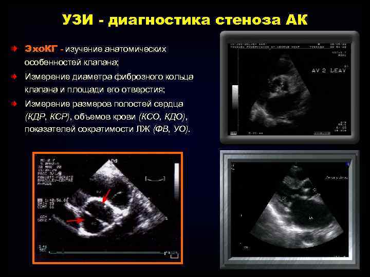 УЗИ - диагностика стеноза АК Эхо. КГ - изучение анатомических особенностей клапана; Измерение диаметра