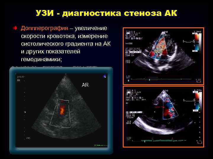 УЗИ - диагностика стеноза АК Допплерография – увеличение скорости кровотока, измерение систолического градиента на