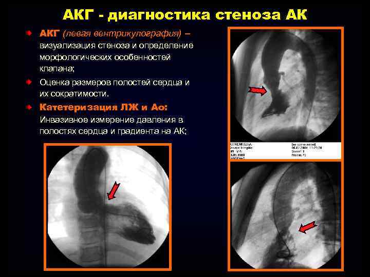 АКГ - диагностика стеноза АК АКГ (левая вентрикулография) – визуализация стеноза и определение морфологических