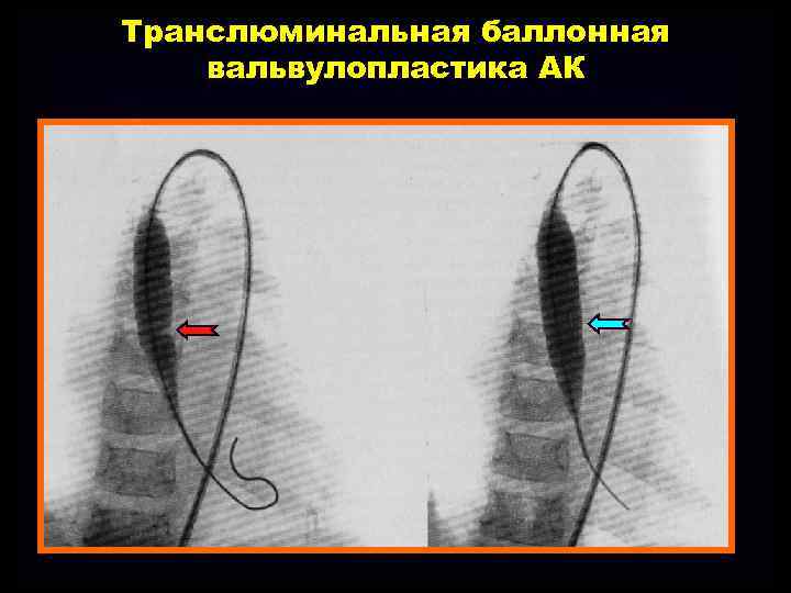 Транслюминальная баллонная вальвулопластика АК 