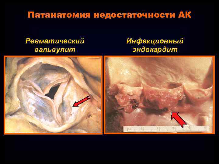 Патанатомия недостаточности АК Ревматический вальвулит Инфекционный эндокардит 