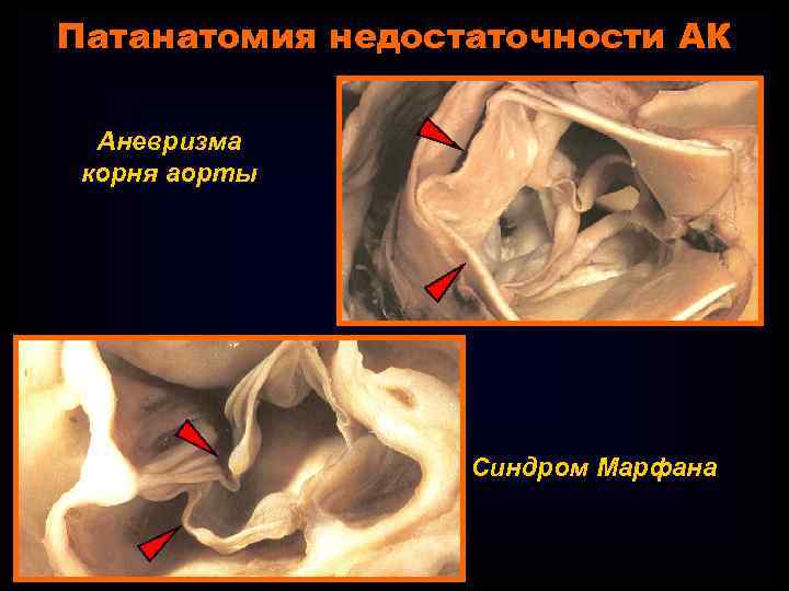 Патанатомия недостаточности АК Аневризма корня аорты Синдром Марфана 