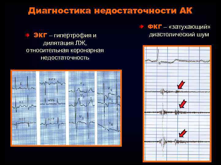 Диагностика недостаточности АК ЭКГ – гипертрофия и дилятация ЛЖ, относительная коронарная недостаточность ФКГ –