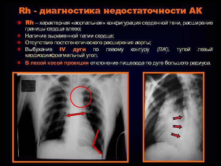 Тень сердца расширена