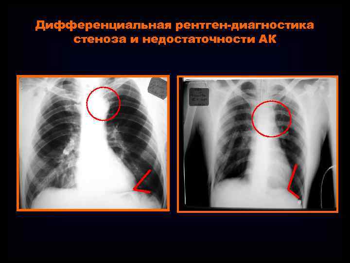 Дифференциальная рентген-диагностика стеноза и недостаточности АК 