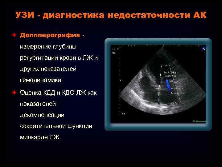 УЗИ - диагностика недостаточности АК Допплерография измерение глубины регургитации крови в ЛЖ и других