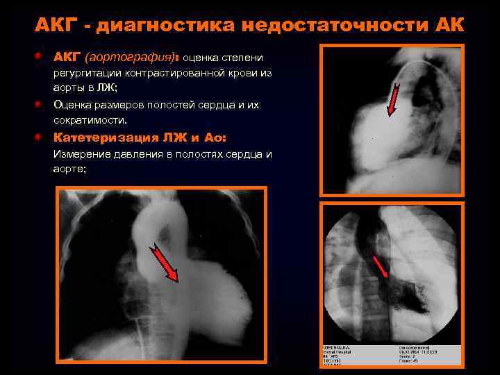 АКГ - диагностика недостаточности АК АКГ (аортография): оценка степени регургитации контрастированной крови из аорты