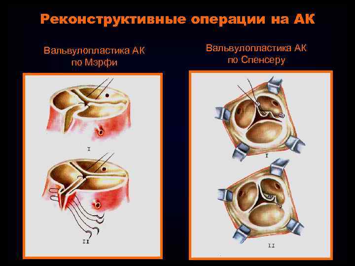 Реконструктивные операции на АК Вальвулопластика АК по Мэрфи Вальвулопластика АК по Спенсеру 