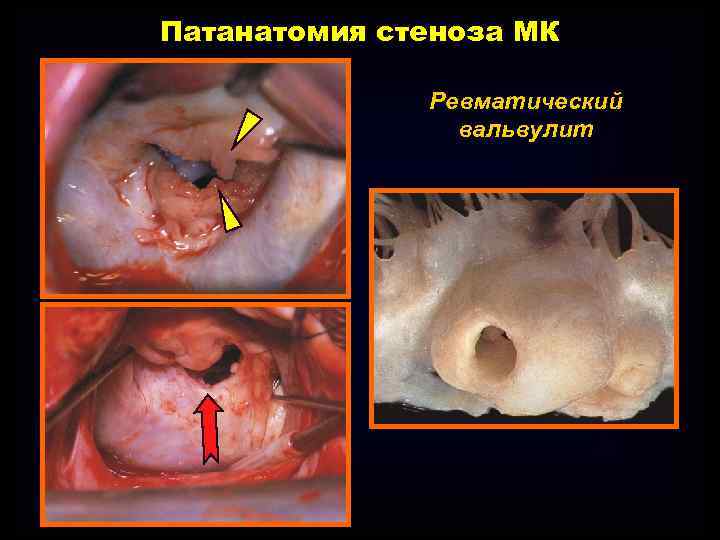 Патанатомия стеноза МК Ревматический вальвулит 