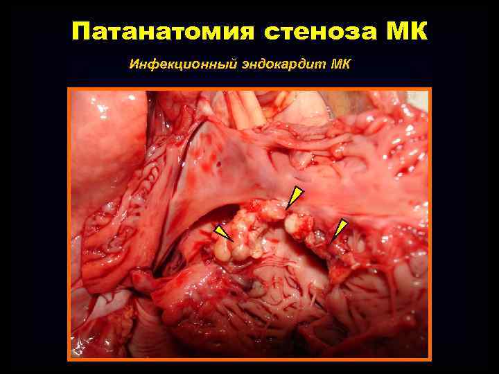 Патанатомия стеноза МК Инфекционный эндокардит МК 