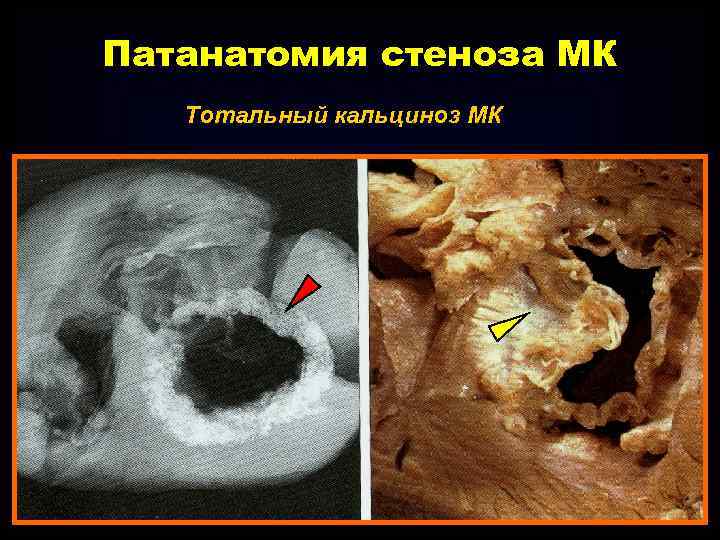 Патанатомия стеноза МК Тотальный кальциноз МК 